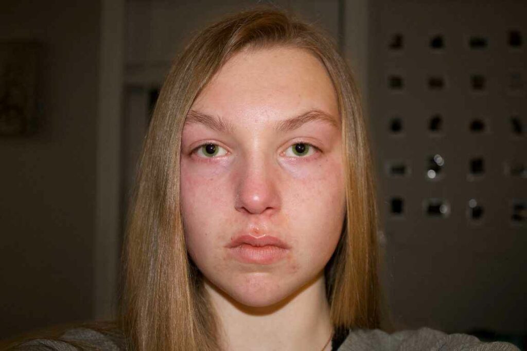Skin Lesions